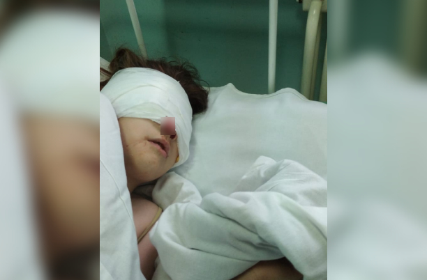В Тверской области собака сгрызла лицо 10-летней девочке