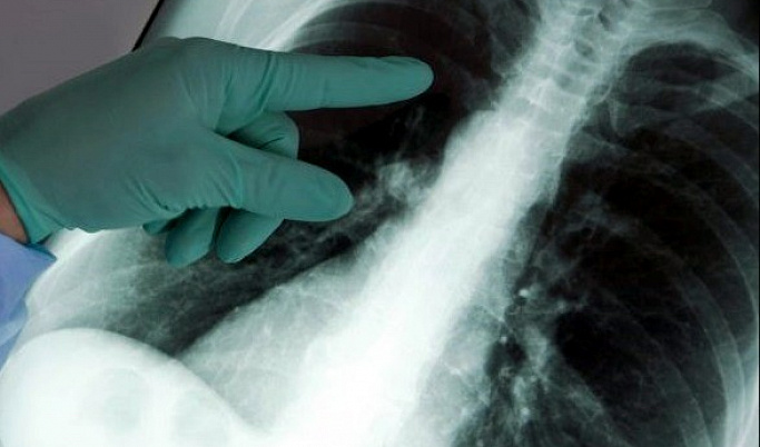 Акция, приуроченная к Всемирному дню борьбы с туберкулезом, пройдет в Твери